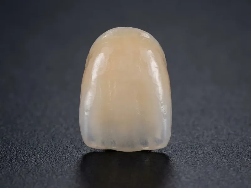 Coroa anterior em cerâmica feldspática